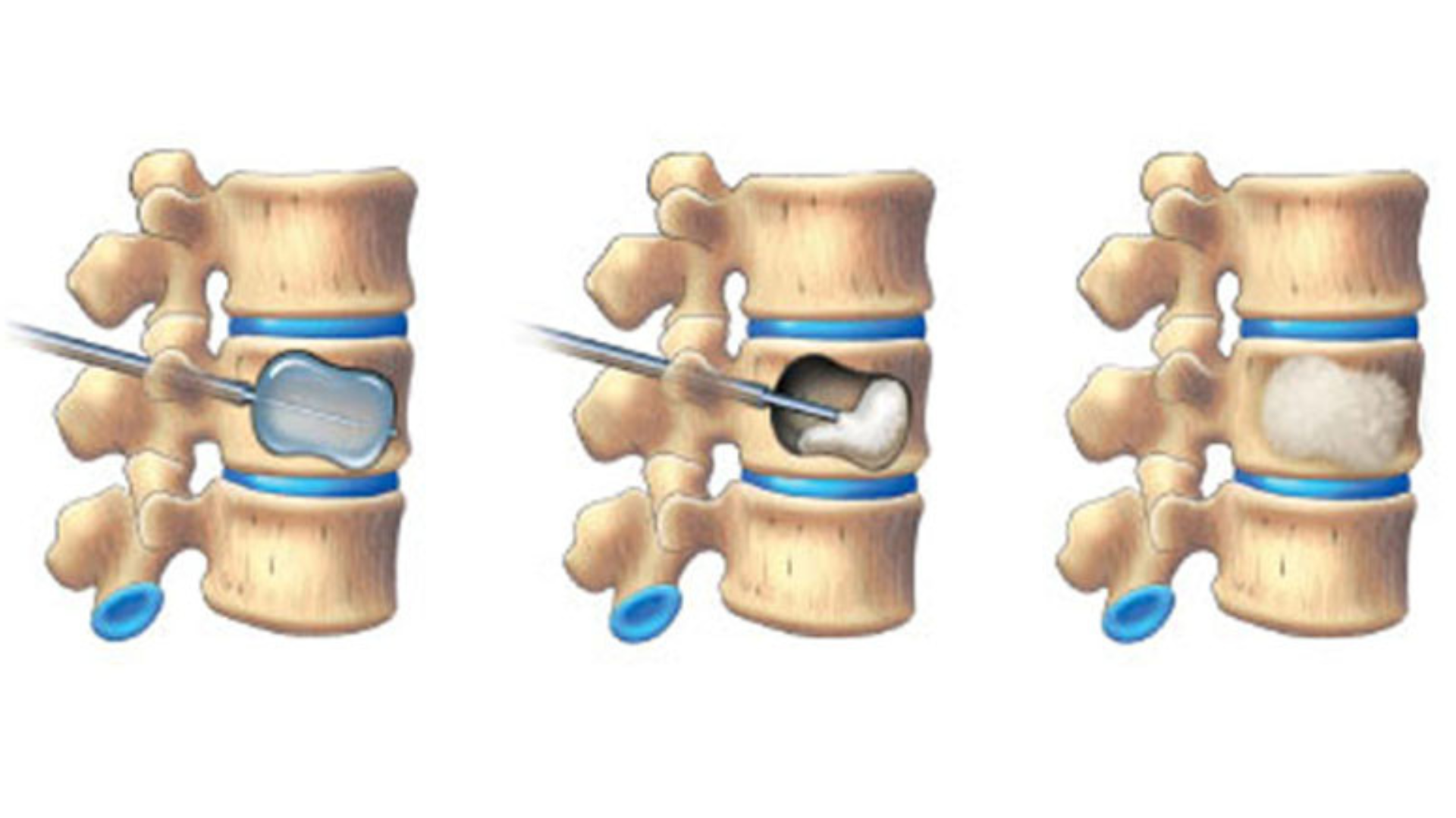 Desenho representativo do procedimento de cifoplastia