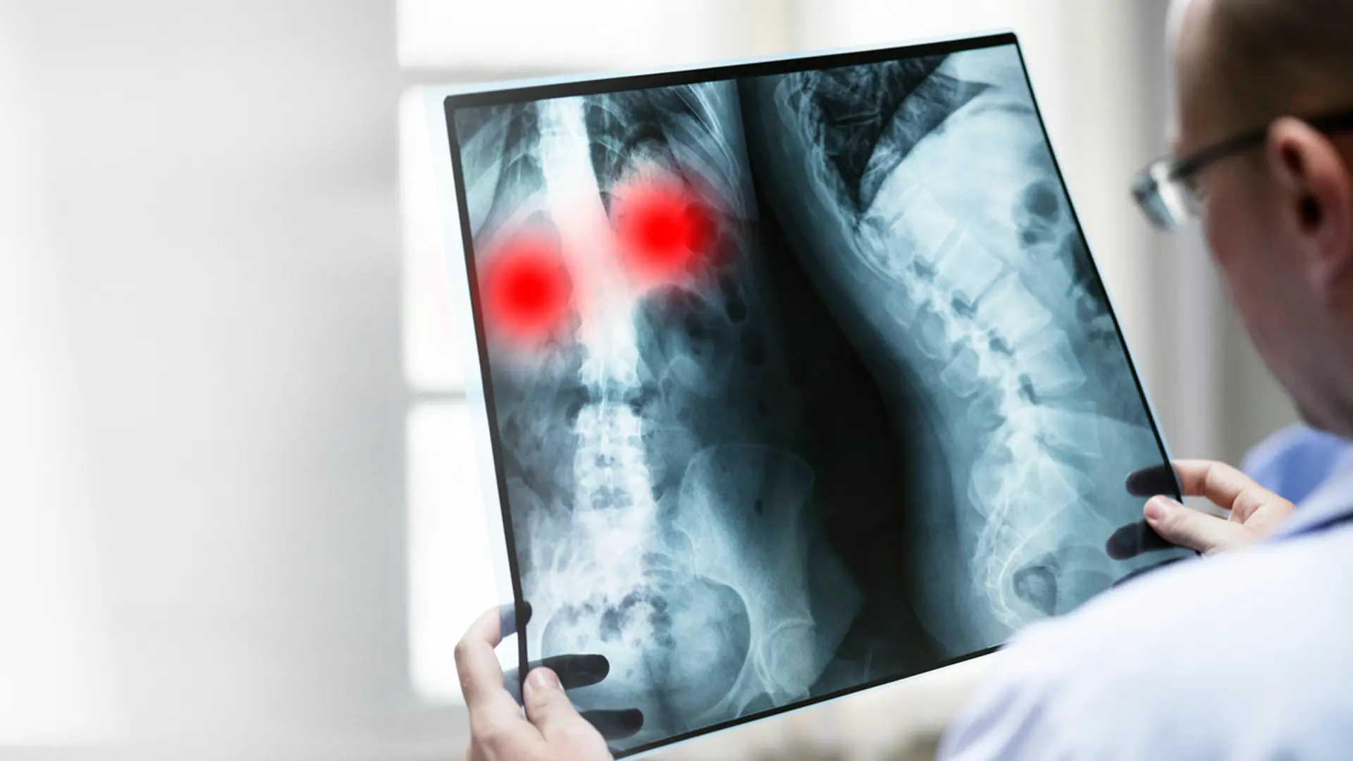 Médico vendo raio-x de uma pessoa com escoliose
