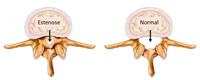 Imagens comparativas mostram a diferença entre um cérebro com e sem compressão da medula