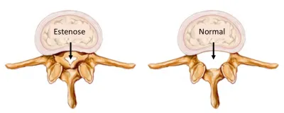 Imagens comparativas mostram a diferença entre um cérebro com e sem compressão da medula