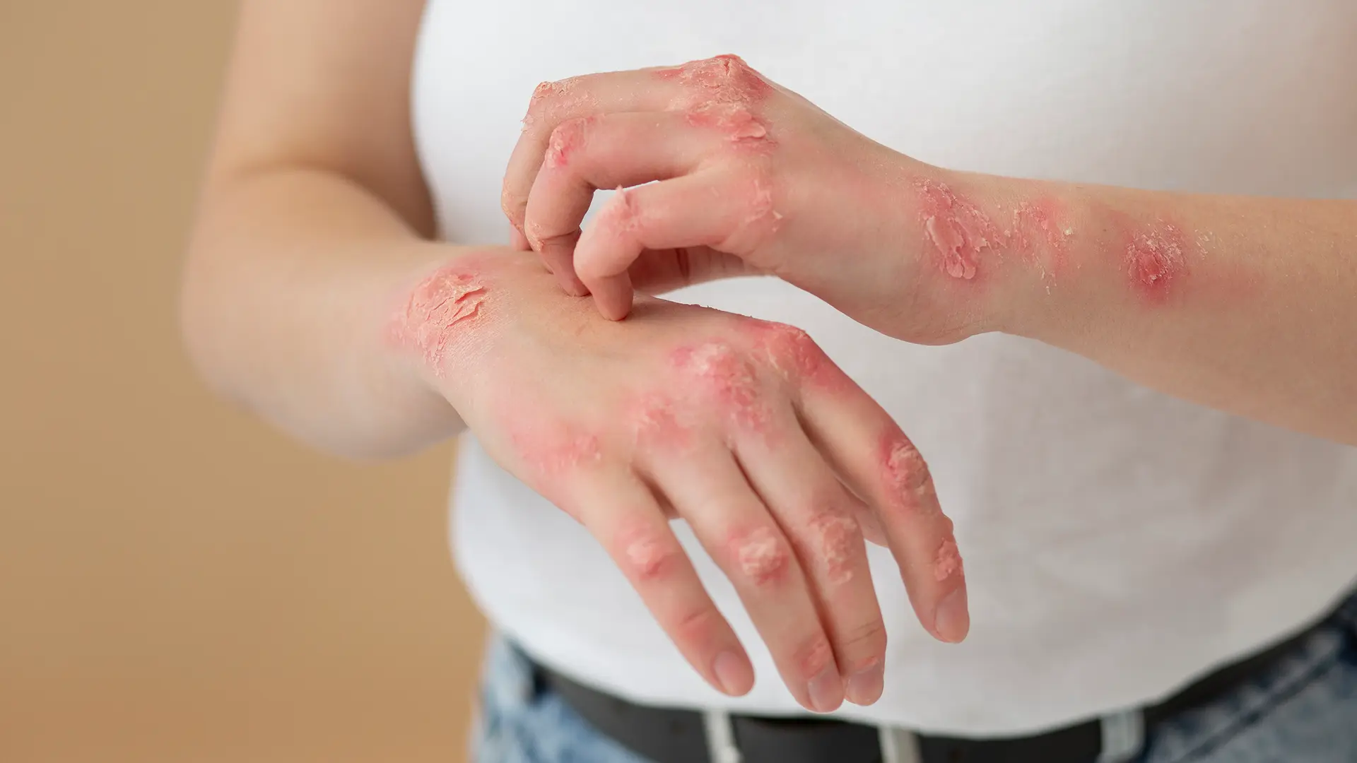Mãos de uma pessoa com as feridas da herpes
